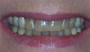 Robinson Dentistry, Betty-before dental care
