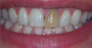 Robinson Dentistry, Carissa-before dental care
