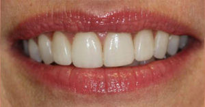 Robinson Dentistry, Heather-after 4 porcelain crowns