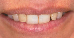 Robinson Dentistry, Heather-before 4 porcelain crowns