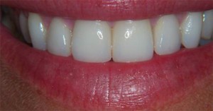 Robinson Dentistry, Traci-after dental care