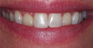 Robinson Dentistry, Traci-before dental care