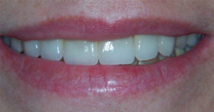 Robinson Dentistry, Jessica-after dental care