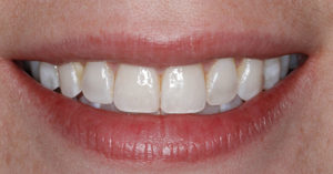 Robinson Dentistry Tracy-after dental care