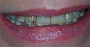 Robinson Dentistry Jessica-before dental care